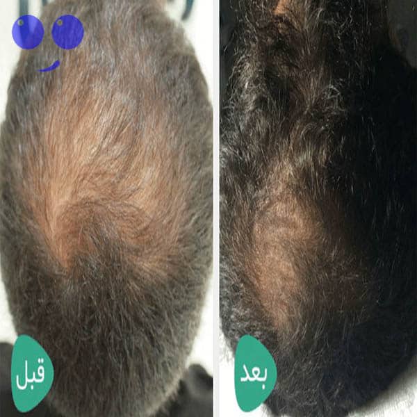 کوکتل رشد مو فیوژن F-Hair 4 کوکتل رشد مو فیوژن F-HAIR