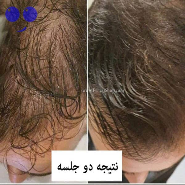 کوکتل رویش مجدد مو ماتریکس Hr3 ژنوسیس 5 کوکتل رویش مجددموماتریکس HR3 ژنوسیس