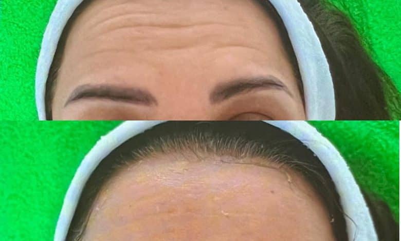 نخ کلاژن جذبی 5 نخ کلاژن جذبی