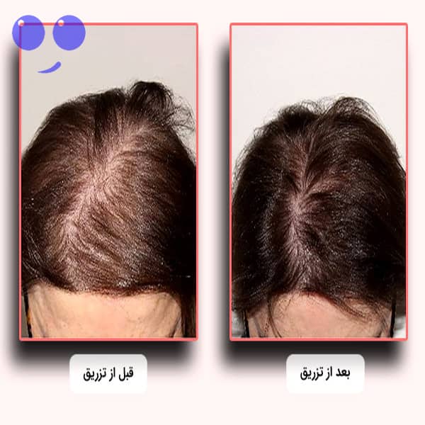 کوکتل مو رویتاکر هیرکر Revita Care 8 کوکتل مو رویتاکر هیرکر revita care